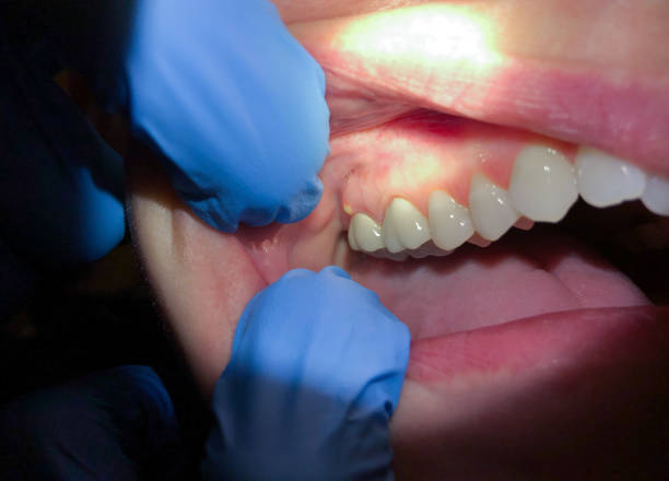 Best Emergency Root Canal Treatment in Copper Canyon, TX